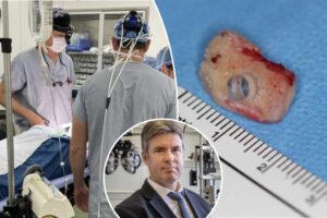 Read more about the article Canadian surgeons implant teeth in eyes to restore sight